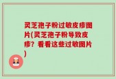 灵芝孢子粉过敏皮疹图片(灵芝孢子粉导致皮疹？看看这些过敏图片)